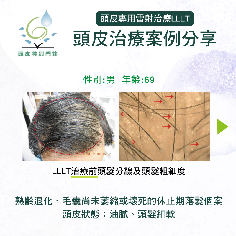 頭皮保養雷射