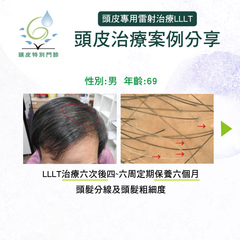 頭皮保養雷射