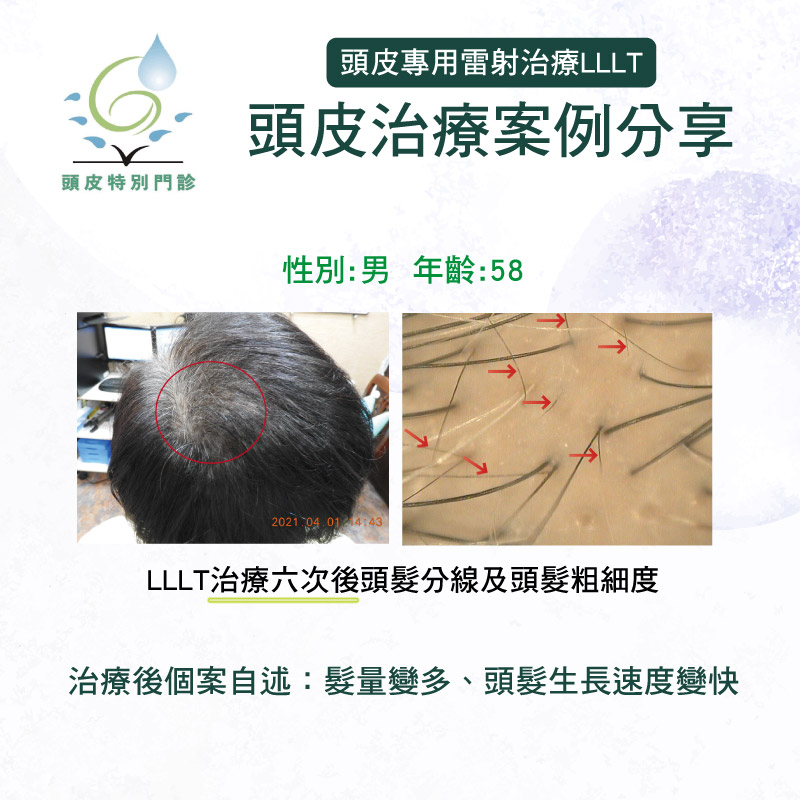 頭皮雷射治療案例分享