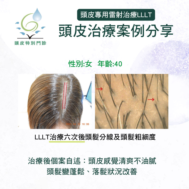 健髮雷射治療案例