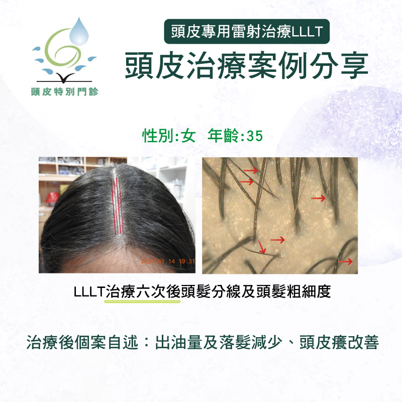健髮雷射案例