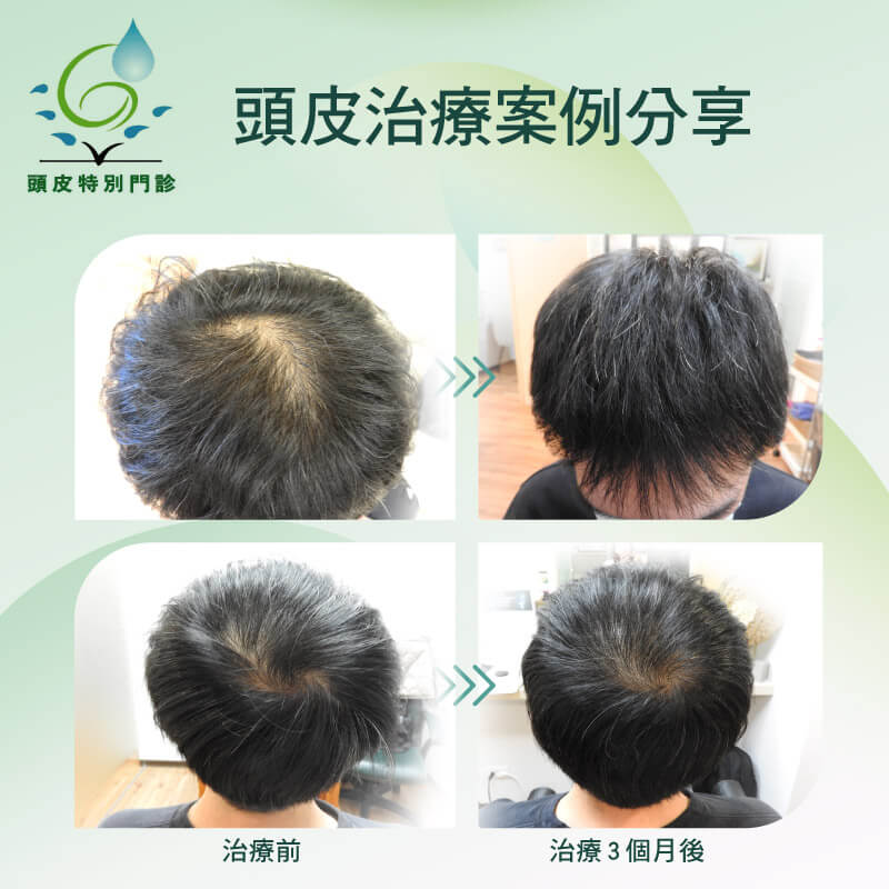 休止期治療案例分享