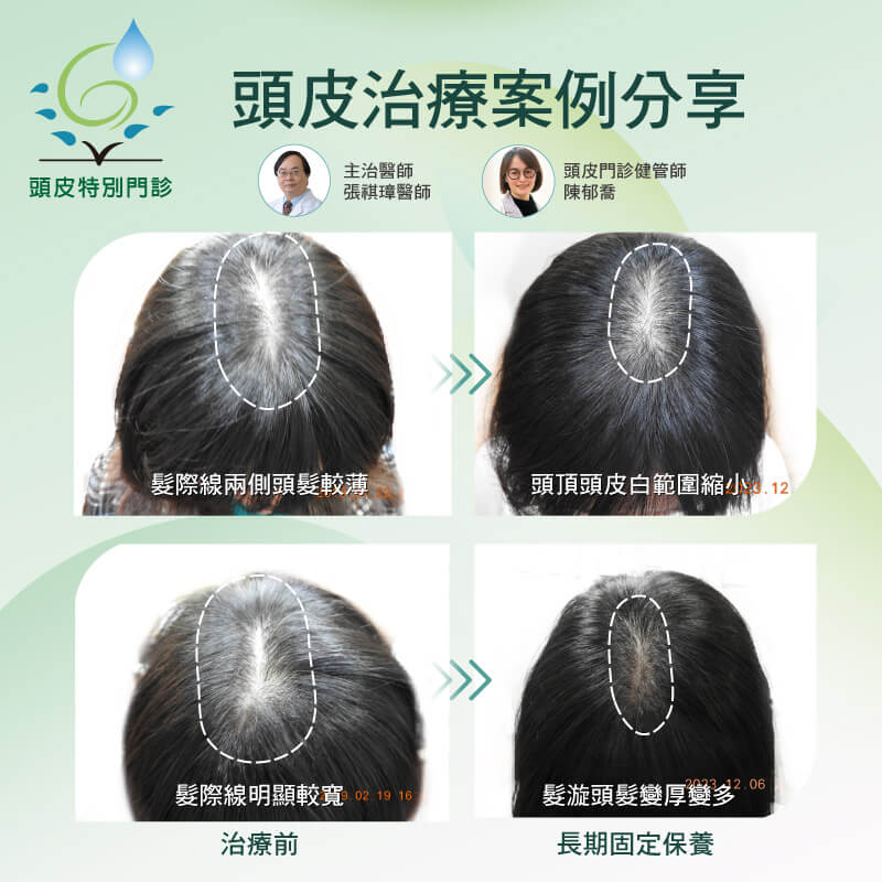 頭皮治療案例分享