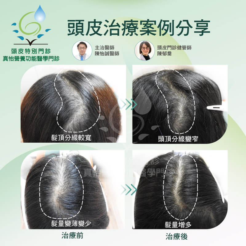 頭皮治療案例分享