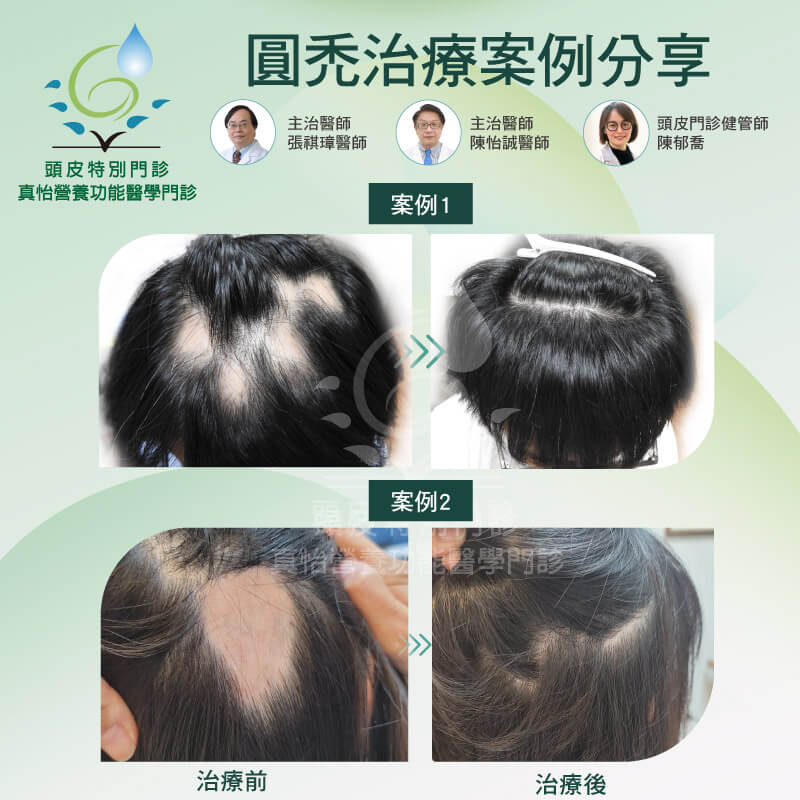 圓禿治療案例分享