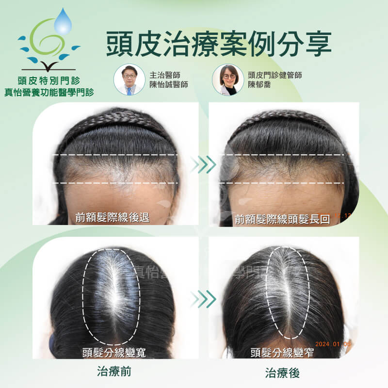 頭皮治療案例分享BA