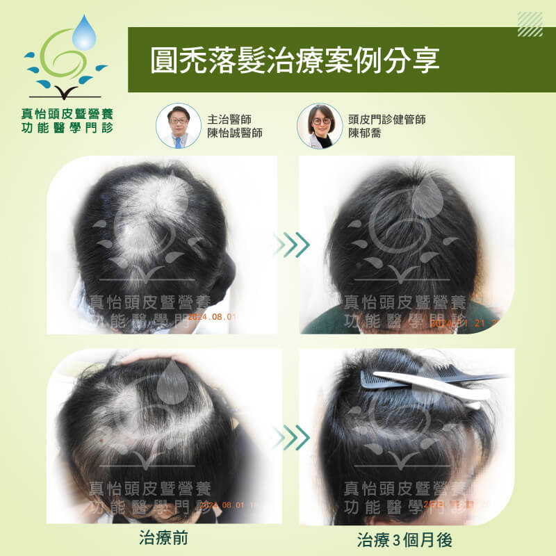 圓禿個案分享