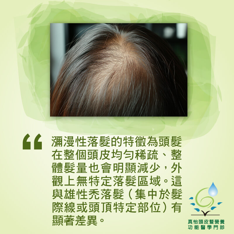 瀰漫性落髮與雄性禿不同