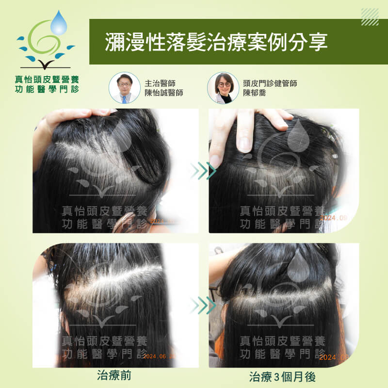 瀰漫性落髮BA照片