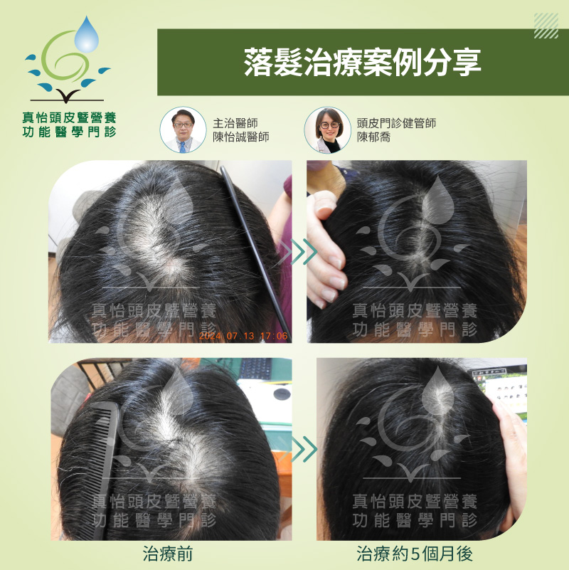 真怡頭皮暨營養功能醫學門診-圓禿長得回來嗎?找出掉髮原因後逐步長回頭髮的真實案例