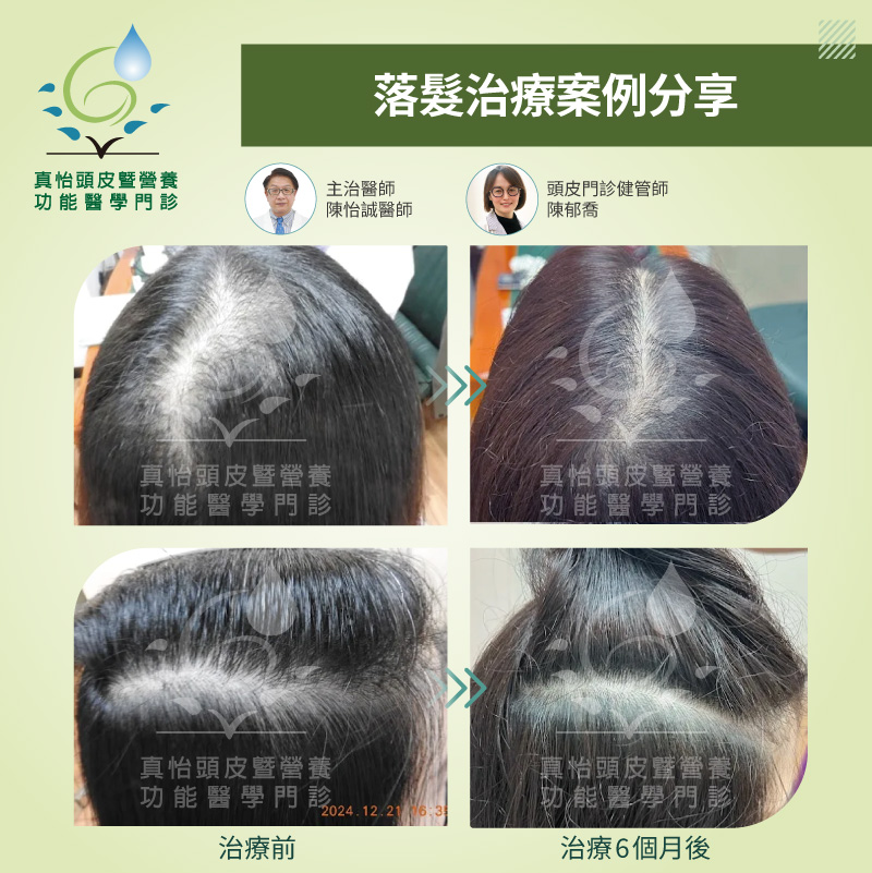 真怡頭皮暨營養功能醫學門診 女性落髮半年改善案例