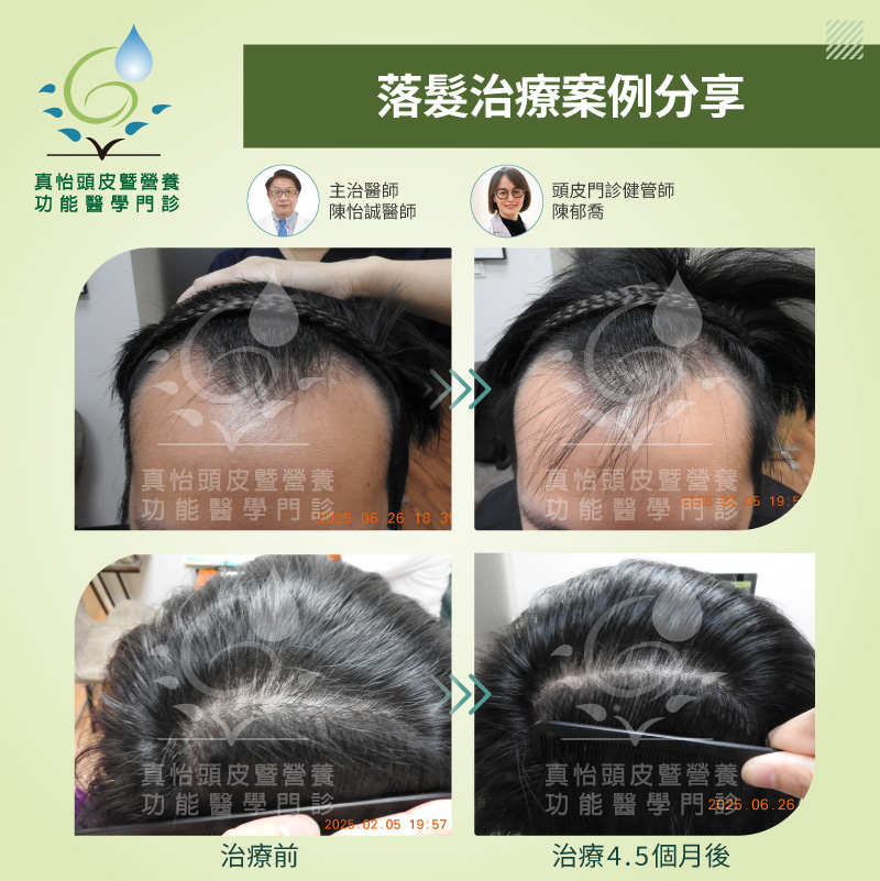 真怡頭皮暨營養功能醫學門診-髮際線後退一定要植髮嗎?男性雄性禿改善案例與治療心得分享