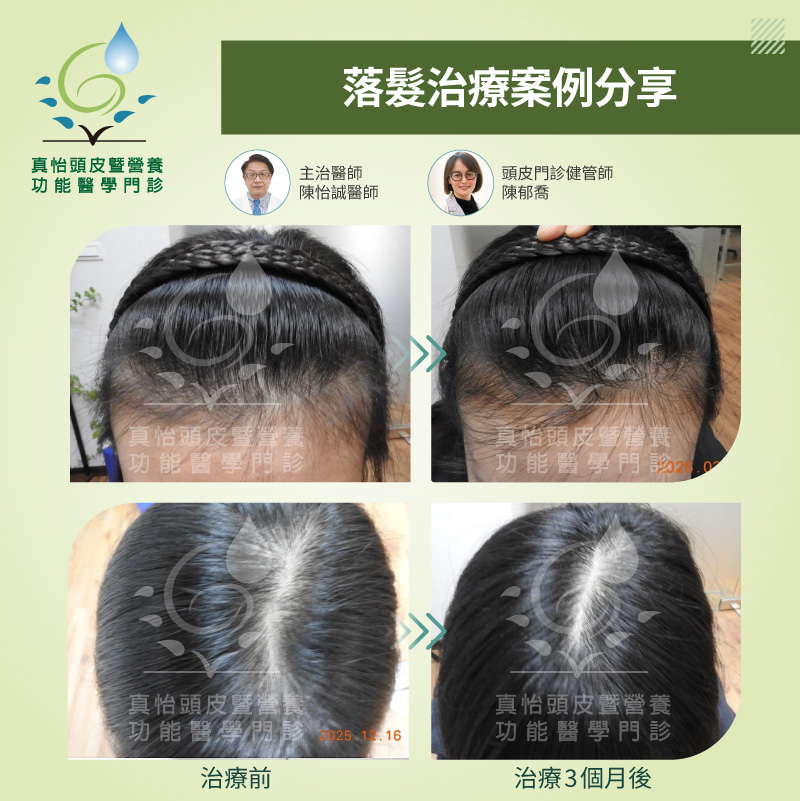 真怡頭皮暨營養功能醫學門診-掉髮原因不只壓力?找出營養與過敏因素後髮縫逐漸改善的真實案例
