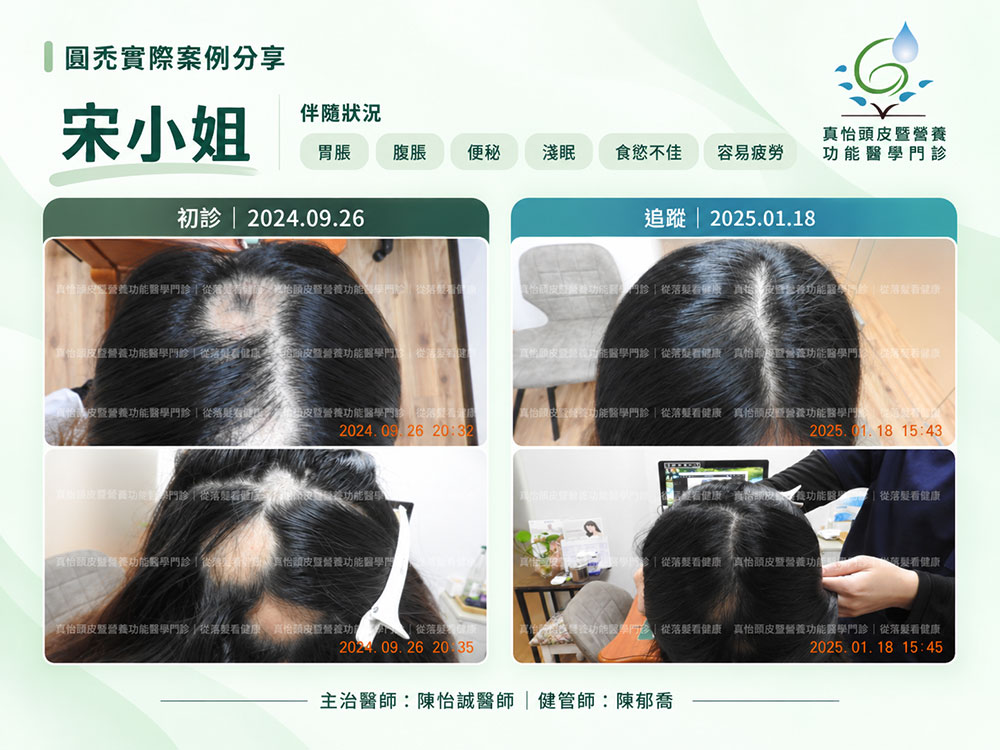 真怡頭皮暨營養功能醫學門診_圓禿治療案例_宋小姐