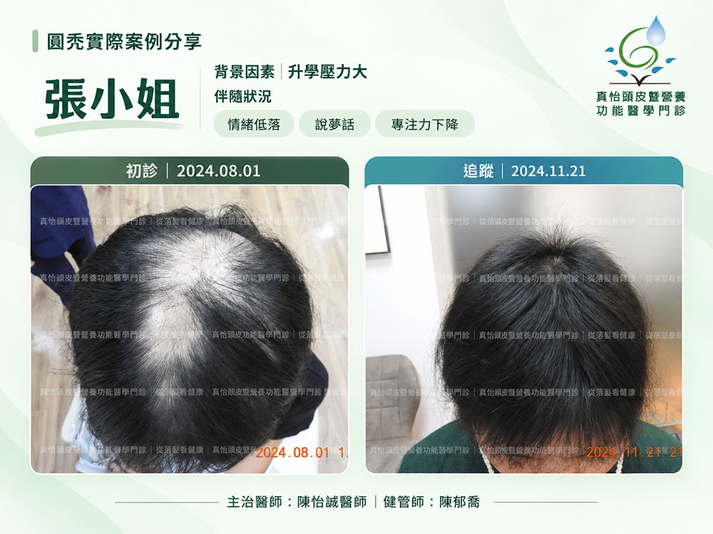 真怡頭皮暨營養功能醫學門診_圓禿治療案例_張小姐