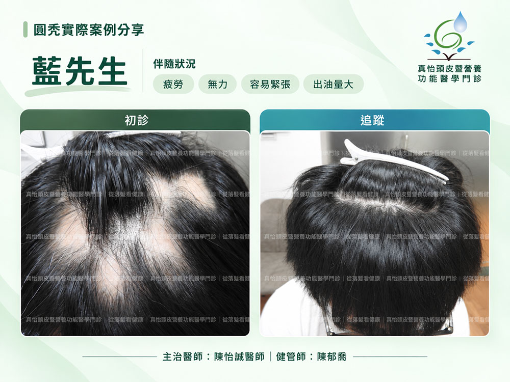真怡頭皮暨營養功能醫學門診_圓禿治療案例_藍先生