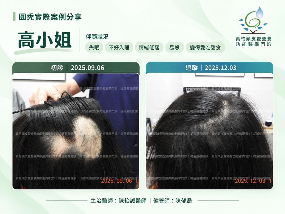 真怡頭皮暨營養功能醫學門診_圓禿治療案例_高小姐