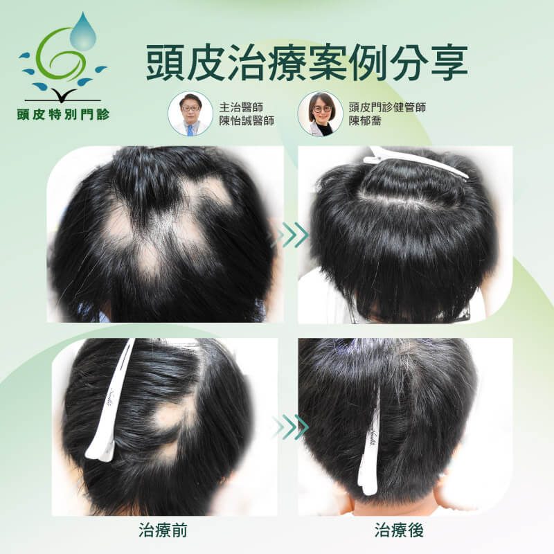圓禿 落髮治療BA